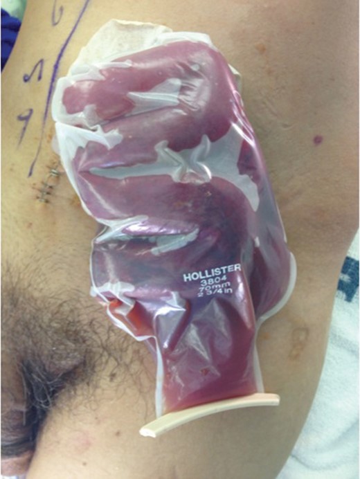 Stomatal bag evisceration.