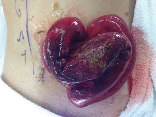 Bowel evisceration A.