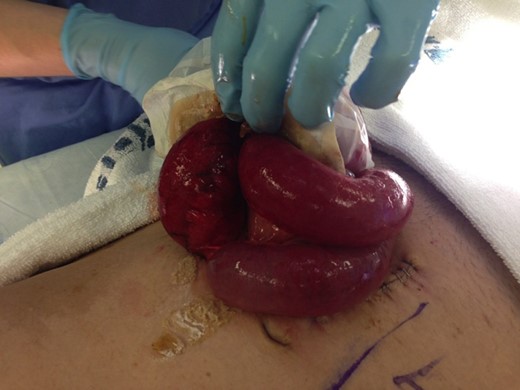 Bowel evisceration B.