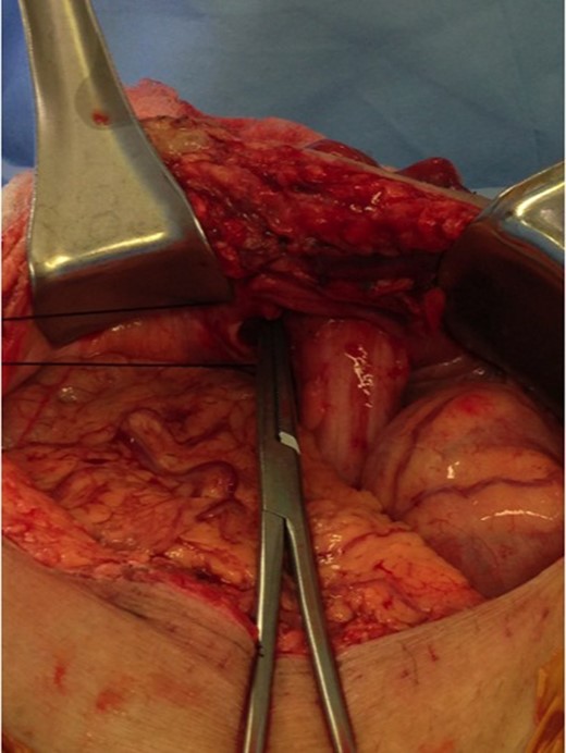 Parastomal defect.
