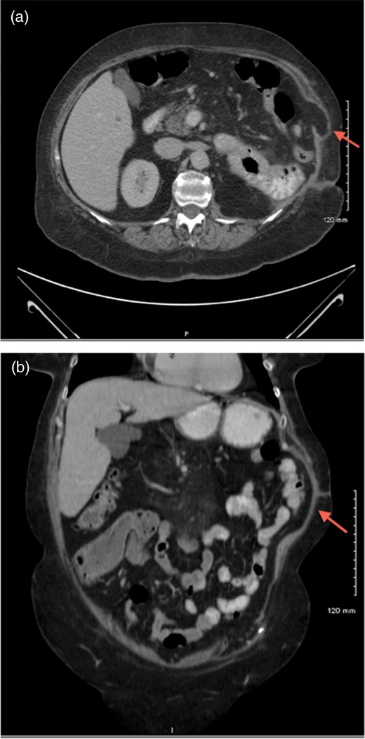 CT scans of abdomen showing a potential abdominal wall hernia (arrows).