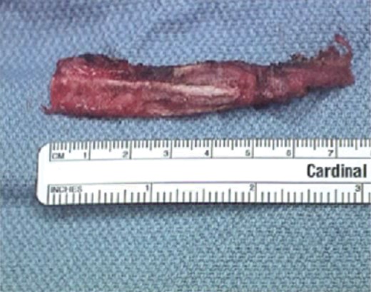 Resected rib.