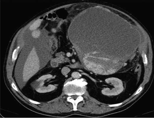 Computed topography abdomen: an intra-abdominal mass.