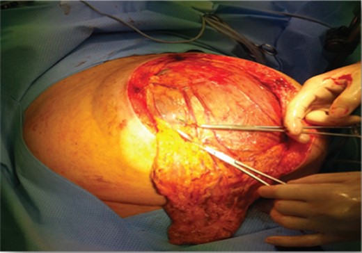 Laparotomy. Omentum surrounding the intra-abdominal mass.