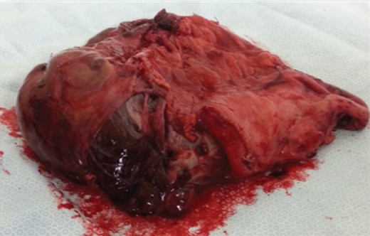 Surgical specimen.