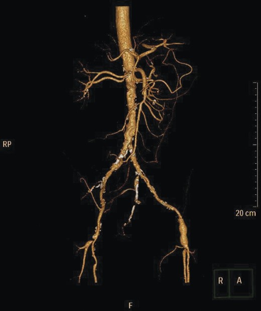 CT angiogram showing IMA and right internal iliac artery completely occluded.