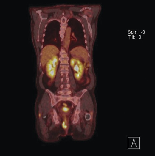 PET scan showing disease localized to the peri-anal region.