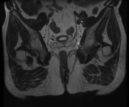 Magnetic resonance image (MRI) scan showing a large posterior abscess cavity with a cavity tracking posterior to the rectum.