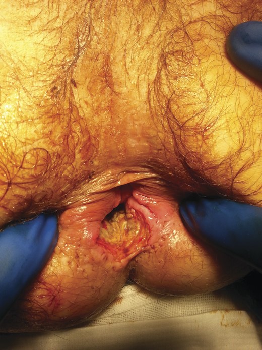 Necrotic internal sphincter and abscess cavity at the posterior aspect of the rectum.