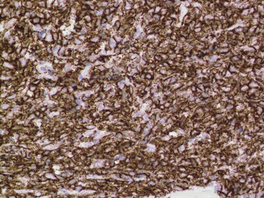 Positive immuno-histochemistry for CD20 indicates a B cell lymphoma.