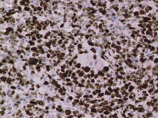 Ki67 stain of lymphoma cells.