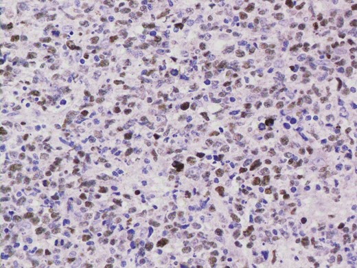 EBV ISH was positive indicating the presence of EBV encoded RNA in the tumour cells.