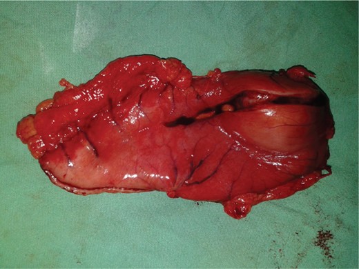 Postoperative resected specimen.