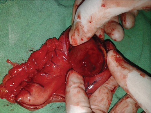 Postoperative resected specimen.