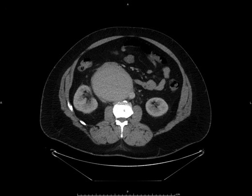 Abdominal computed tomography showing the recurrent lesion.