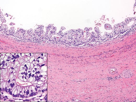 Pathology slide showing recurrent teratoma.
