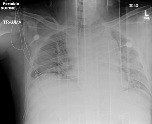 Initial chest X-ray.