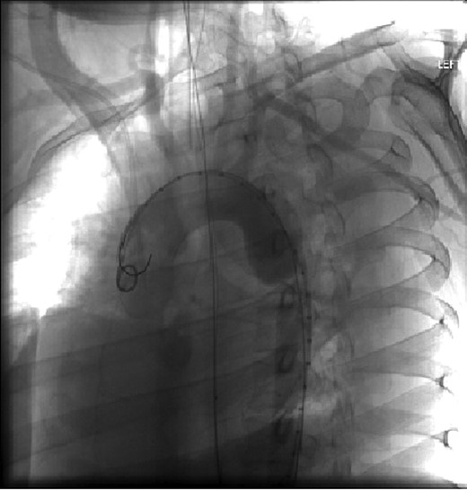 Aortic arch and descending thoracic aorta visualized by CTA with contrast pre-placement of stent.