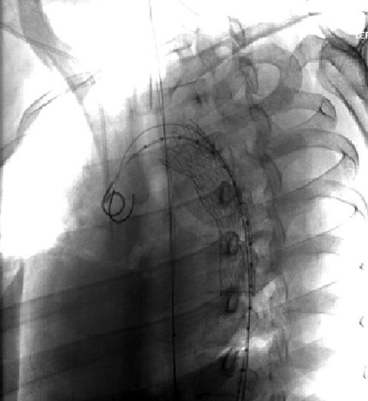 Visualization of the aortic arch and thoracic aorta after stent placement.