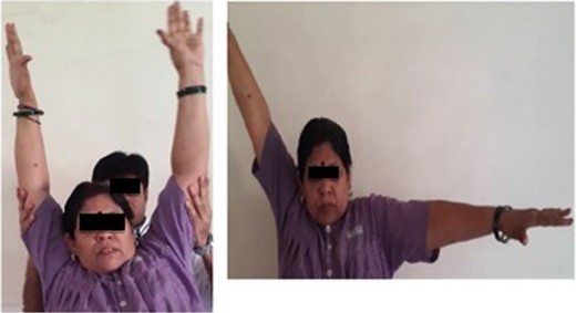 Clinical photograph of passive (left) and active (right) abduction of the left shoulder joint.