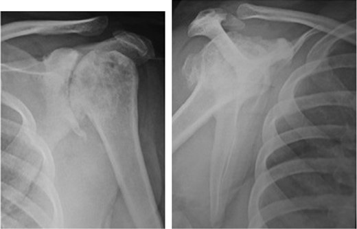 Antero-posterior and scapular radiograph of the left shoulder joint showing severe reduction in glenohumeral joint space, slight superior subluxation of the humeral head, severe subchondral sclerosis and osteophytic changes, subchondral cysts and change in shape of the humeral head. Loose bodies were also present.