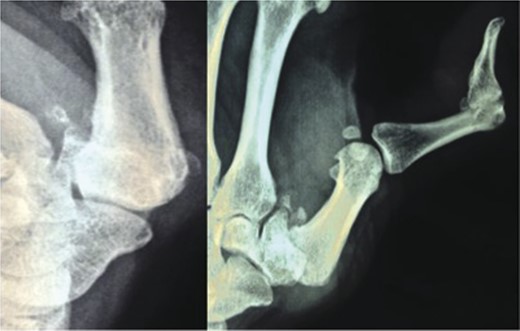 Posterio-anterior and oblique photograph of the left thumb showing severe arthritic changes in the first CMC joint with severe reduction in joint space, volar subluxation, subchondral sclerosis, osteophytic changes and loose bodies.