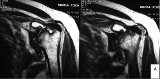 MRI of the left shoulder joint confirming severe arthritic changes, including synovial thickening and destruction of the shape of the humeral head. The rotator cuff was essentially normal with only slight degenerative changes.