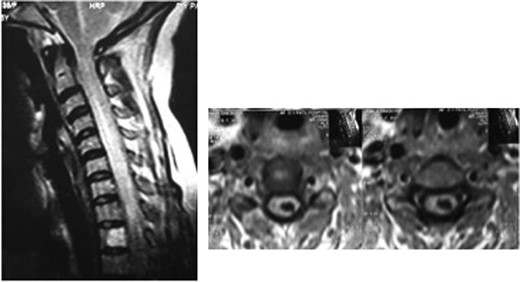 Cervical spine MRI showing a multi-level syringomyelia of the cervical spine.