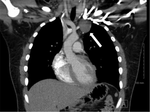 Computed tomography demonstrating a mass in the left chest involving the brachiocephalic vein.