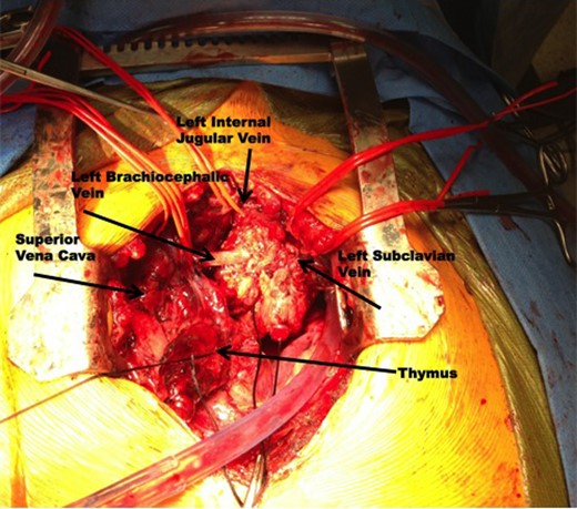 Intraoperative photography demonstrating the epithelioid hemangioendothelioma encasing the left brachiocephalic vein, left internal jugular vein, and left subclavian vein.