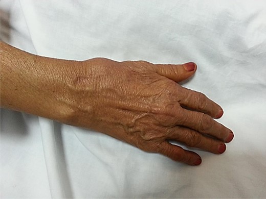 Photo of the right hand of the patient shows a bulge at the snuffbox area.