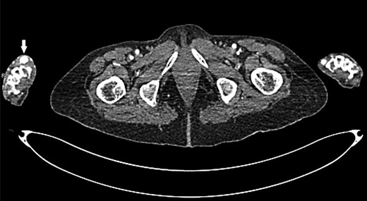 Transverse section of CT angiogram shows radial artery aneurysm at right hand (arrow).