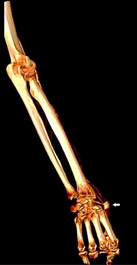 Reconstructed three-dimensional image shows radial artery saccular aneurysm (arrow).
