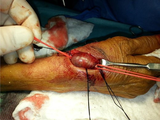 The aneurysm with the radial artery controlled proximally and distally.