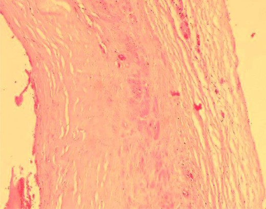 Microscopic view of the aneurysmal wall shows the muscular layer.
