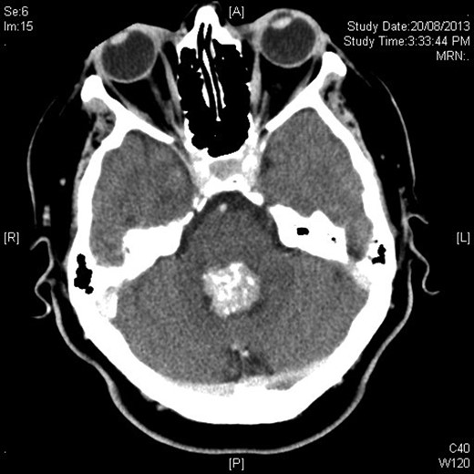 Axial contrast-enhanced CT showing hyperdense rounded lesion in fourth ventricle.
