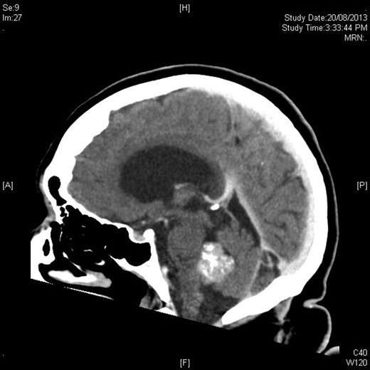 Sagittal figure contrast-enhanced CT brain showing intimate relationship to choroid plexus and associated ventricular dilatation.