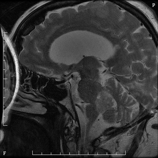 MRI sagittal T2 sequence with gadolinium showing rounded mass in fourth ventricle.