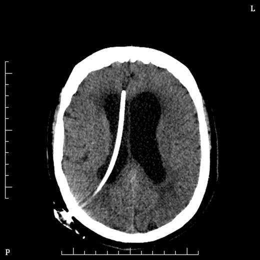 Axial figure CT brain, after insertion of VP shunt.
