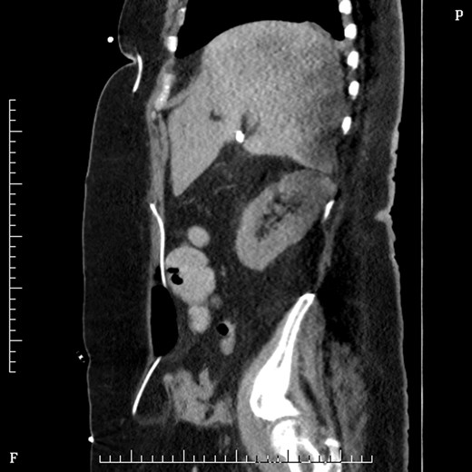 Sagittal figure CT abdomen, demonstrating catheter entering abdomen and re-exiting out the umbilical hernia.