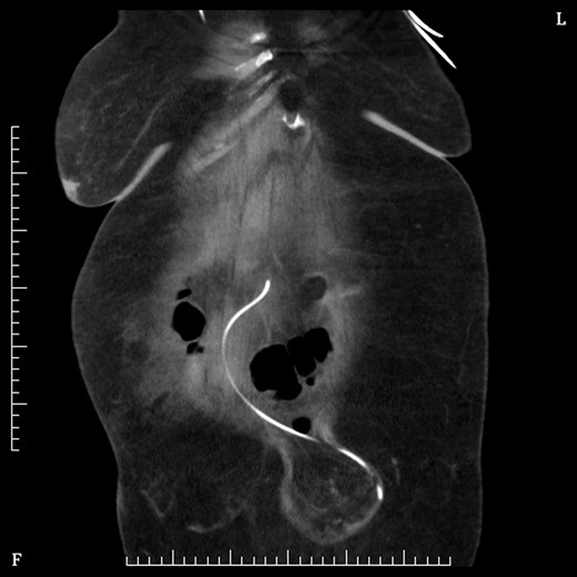 Coronal section CT abdomen after second shunt revision showing catheter again protruding out through umbilicus into hernia sac.