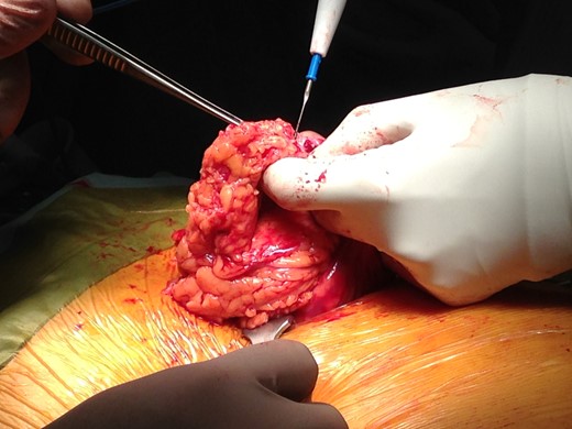Intraoperative photograph of the resected hernia.