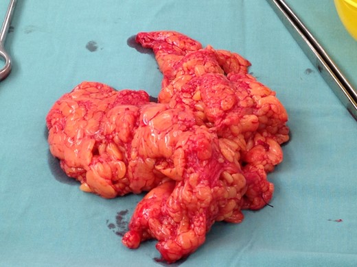 Intraoperative photograph of the resected hernia.