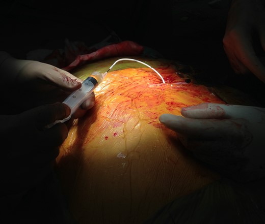 Intraoperative figure demonstrating shunt patency by aspirating CSF from distal catheter end.
