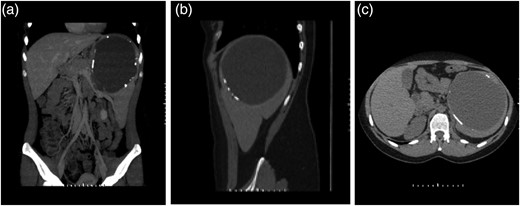 CT scan of the abdomen and pelvis without contrast, showing the 16 cm splenic cyst with partially calcified rim. (a) Coronal view, (b) saggital view, (c) cross-sectional view.