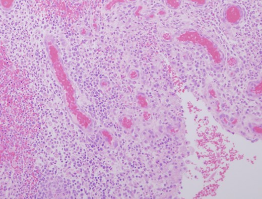 Granulation tissue and micro abscess formation in total duct excision specimen (HE ×200).