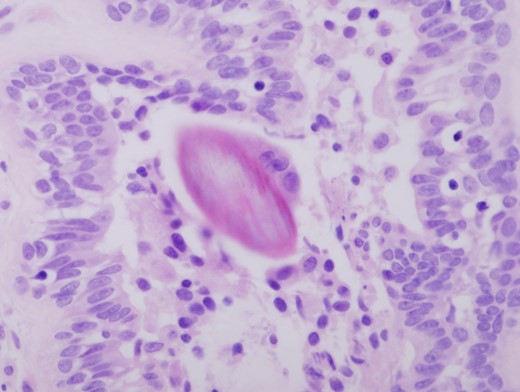 Hair shaft material in a duct with associated chronic inflammation (HE ×400).
