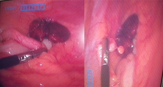 Intraoperative images showing normal appearing appendix with torted parietal peritoneal lipoma.