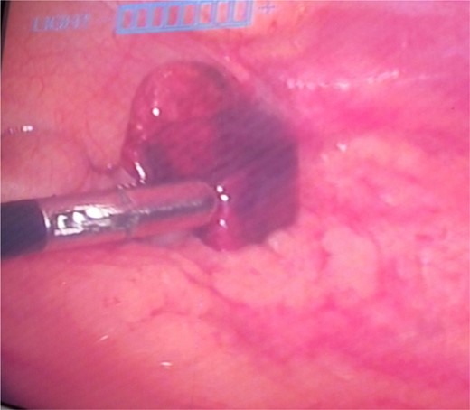 Intraoperative image showing torted ischemic parietal peritoneum lipoma in RIF.