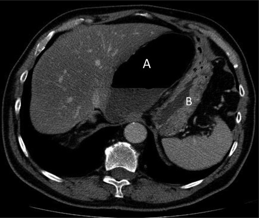 Axial section through upper abdomen showing distended caecum with air-fluid level (A) with the displacement of the stomach (B) laterally.